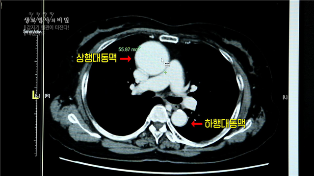 스틸 = KBS 생로병사의 비밀