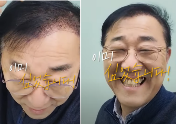 자신의 페이스북과 유튜브 계정에 모발이식 인증을 한 김윤덕 의원.  출처=김윤덕 유튜브 캡쳐